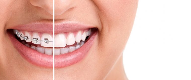 10 Tips Menjaga Mulut Sehat untuk Pemakai Behel